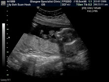 Vivian Sonograms